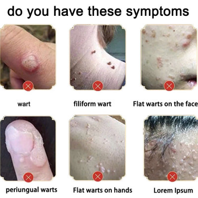 Kem Trị Mụn Cóc, Mụn Thịt, Mụn Cơm Hiệu Quả Sau 7 Ngày – Chiết Xuất Thảo Dược An Toàn 20g