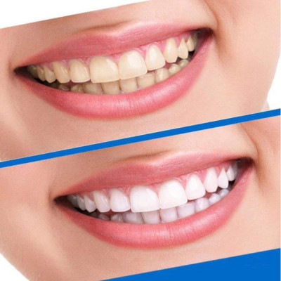 Full hộp 7 cặp - 14 miếng dán trắng răng 3D White Teeth Whitening Strips Sena Beauty, mạnh gấp 25 lần kem đánh răng