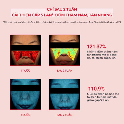 Toner Acid Giảm Thâm Nám Chuyên Biệt Angel