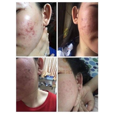 Tinh Chất Sâm Đất DR CELL 50ml tái tạo da, triệt tiêu mụn, mờ thâm nám, thu nhỏ chân lông