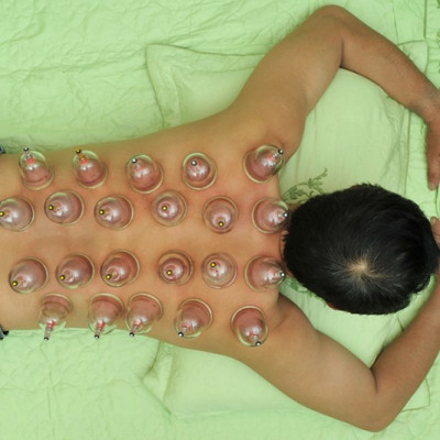 Bộ Giác Hơi Không Dùng Lửa Duy Thành YGH05 (6 ống giác)