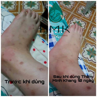 Combo 2 lọ Tinh Chất Mờ Thâm Minh Khang